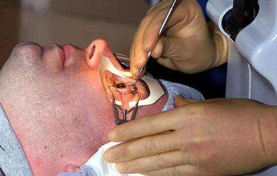 Escleroplastia para la miopía para estabilizar la visión.