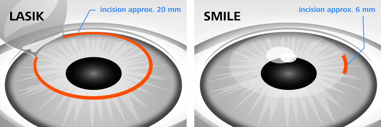 Comparación de los métodos de corrección de la visión con láser LASIK y SMILE